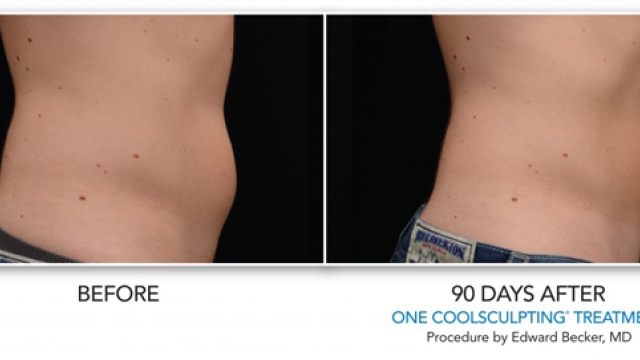 Frosting Away Fat: Exploring the Magic of Cool Sculpting