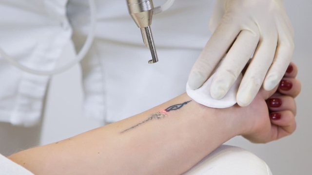 Tattoo Removal Options – What Options Do In Order To