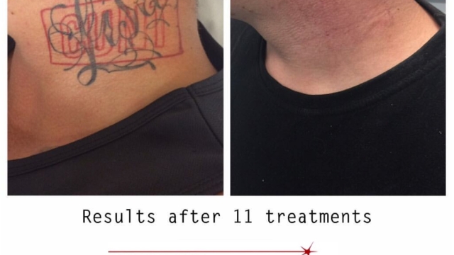 Tattoo Removal Options – Available Solutions To Remove It