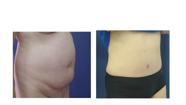 Tummy Tuck: Sculpting a Flatter, Beautiful Abdomen