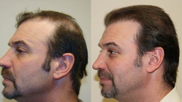 Bald No More: The Ultimate Guide to Hair Implants