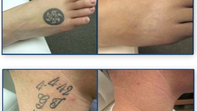 Laser Tattoo Removal – How Long Does It Take?