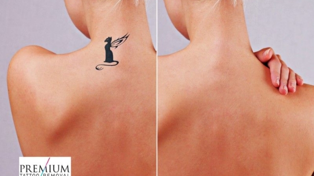 Tattoo Removal – This Is How To Participate The Right And Safe Way