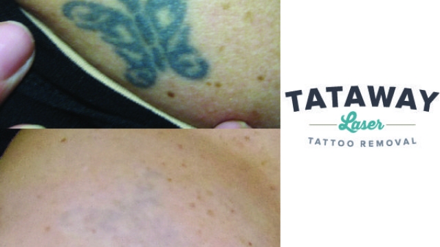 Top 4 Tattoo Removal Programs Take Into Account